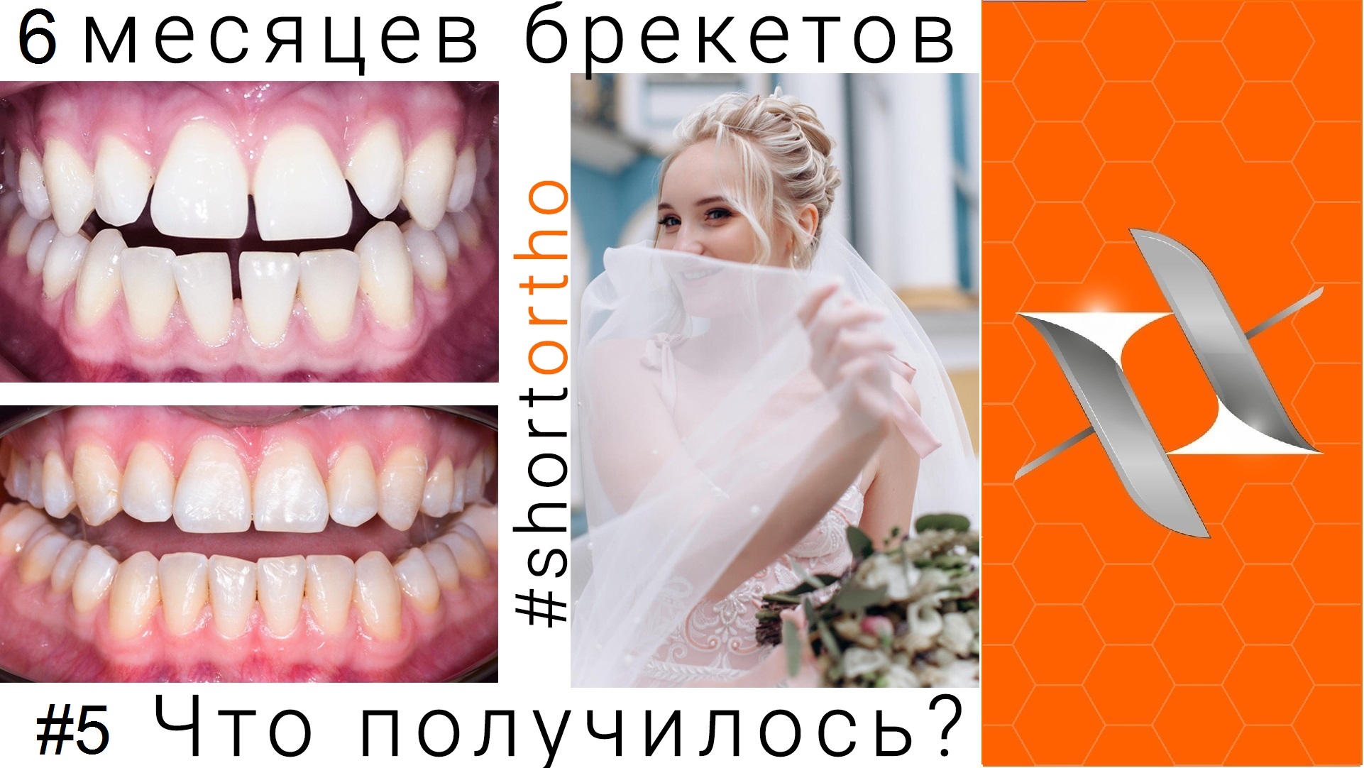 Ортодонтическое лечение на брекетах за 6 месяцев!  (До и после).Выводы. #Shortortho