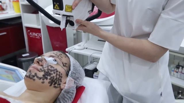 Карбоновый пилинг | Клиника Dental&Beauty смотреть онлайн