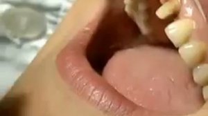 Безметалловые коронки на зубы (установка)