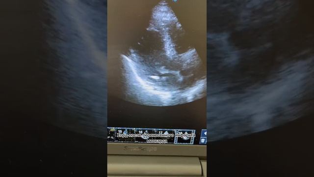 Осложнения после инфаркта миокарда. Частичный отрыв хорд. Тромб. смотреть онлайн