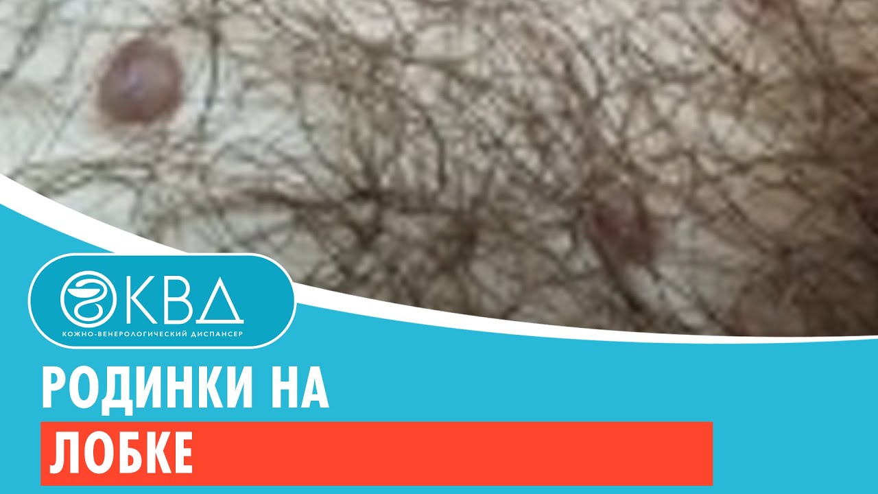 Родинки на лобке. Клинический случай №142