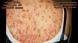 ★ Почему появляются ПРЫЩИ на разных частях тела. Будь внимателен! Это  СИМПТОМЫ заболеваний.