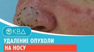 ✅ Удаление опухоли на носу. Клинический случай №927