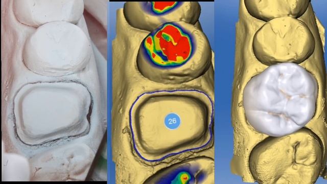 Керамическая коронка на cerec , керамические виниры , sirona , лечение зубов , коронки на зубы