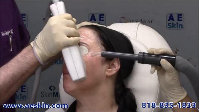 Forever Young BBL IPL Photofacial Demonstration 17- A E Skin - Encino, CA - 818-835-1833 смотреть онлайн