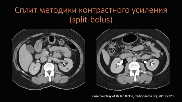 КТ Абдоминальная визуализация 16 Лекция «КТ почек и МВС» Лектор Пихута Д А смотреть онлайн