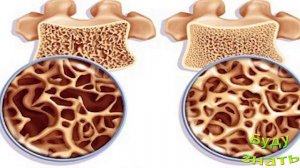 Остеопороз - это Серьезно! Как помочь?