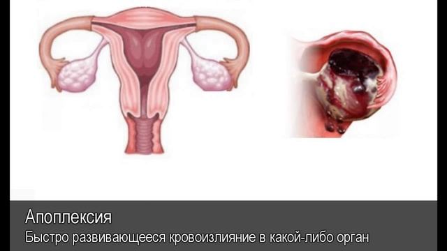 Апоплексия. Толковый Видеословарь русского языка