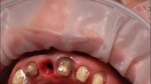 Формователь десны