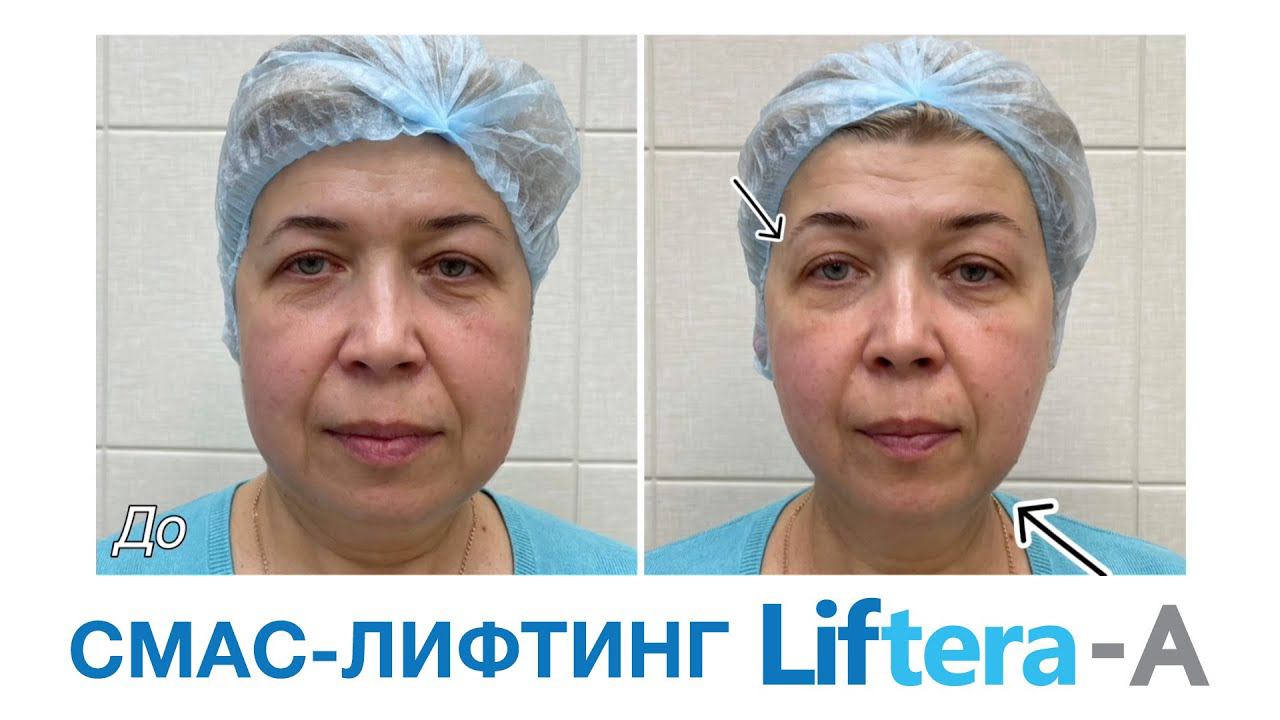 смаслифтинг  Безоперационная ультразвуковая подтяжка лица