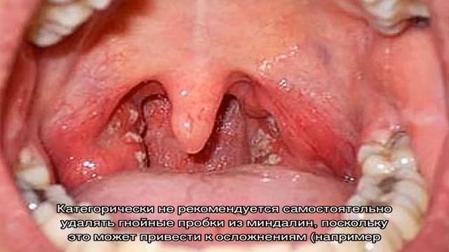 Ангина - белый налет на языке смотреть онлайн