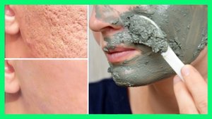 Натуральная маска от Пигментных пятен, от следов после Акне и Прыщей с моментальным эффектом