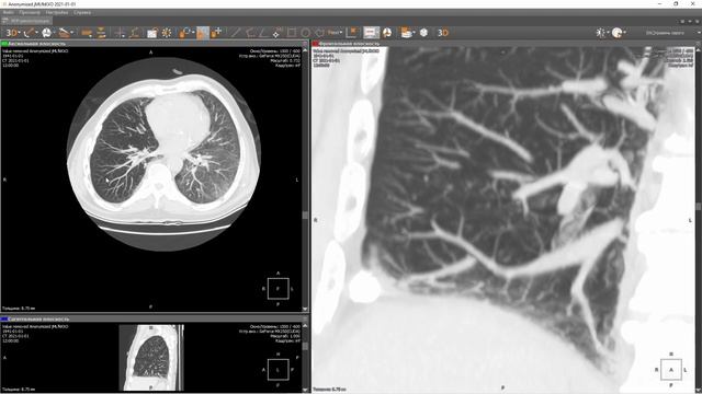 Андрей Кастарнов. Пятигорск. Разбор интересных случаев в торакальной радиологии. смотреть онлайн