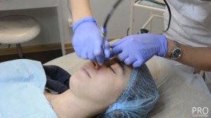 Алмазный пилинг на аппарате Pristine - как проходит процедура