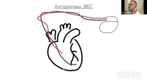 Интерпретация ЭКГ у пациентов со стимуляторами. ЭКГ картина современных алгоритмов кардиостимулятор