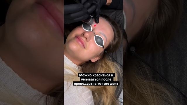 Процедура удаления татуажа бровей лазером #лазерноеудалениетатуажа #лазерноеудалениетату