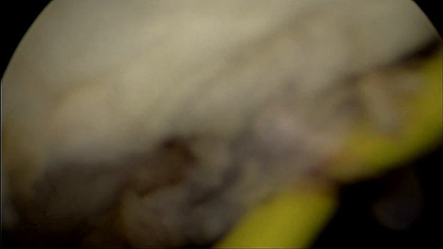 Гистероскопия. Резекция субмукозного узла