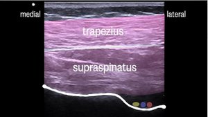 Блокада надлопаточного и подмышечного нервов
