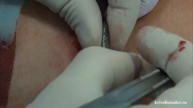 Удаление временного сакрального квадриполярного электрода смотреть онлайн