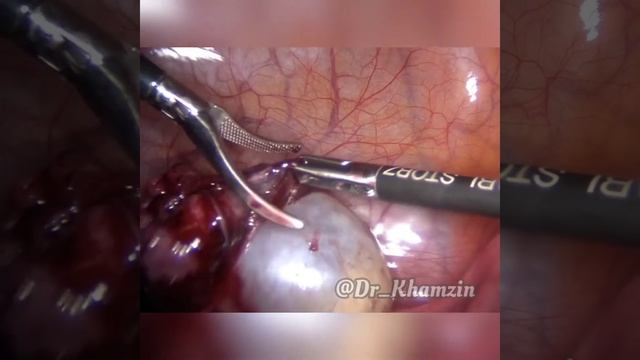 Лапароскопия, удаление цистаденомы левого яичника (кистэктомия) смотреть онлайн