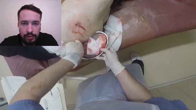 Флегмона бедра. Вскрытие. Дренирование. Дренаж. Phlegmon of the thigh. Autopsy. Drainage.