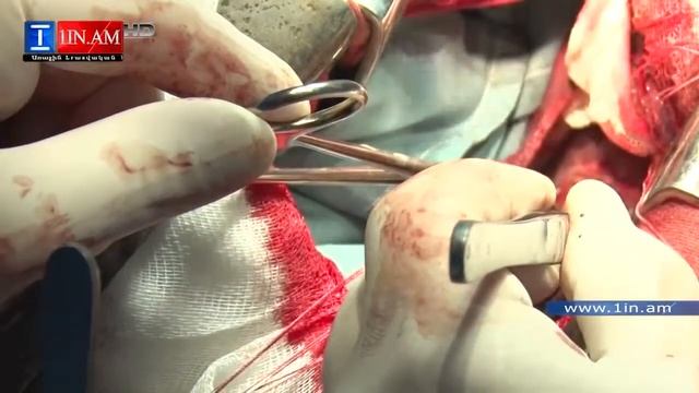 էխինակոկ 6 7 սմ որդի հեռացումը լյարդից բացառիկ նկարահանում վիրահատարանում смотреть онлайн