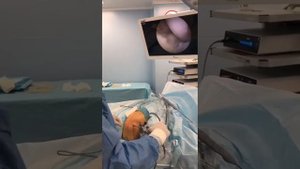 Артроскопия коленного сустава в сочетании с пластикой MPFL