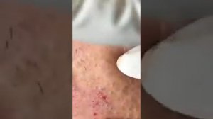 Pimple popping | Cyst popping | Прыщи | Акне | Жесть | Ужасы | Мерзко | Acne | Pimple