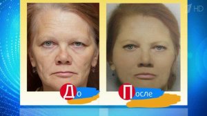 Прощайте, морщины! Здоровье. Фрагмент выпуска от 22.06.2014