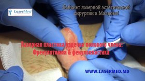 Лазерная френулотомия пластика уздечки& френулопластика в Молдове Кишиневе !