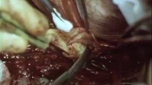 Хирургия брюшной аорты и висцеральных артерий при окклюзиях, 1978