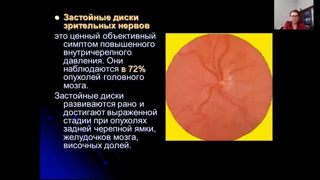 Опухоли головного мозга
