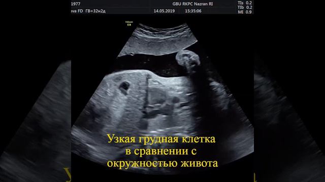 Танатофорная дисплазия