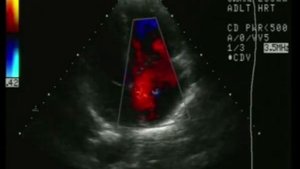Дефект межпредсердной перегородки, эхокардиография после 45 лет