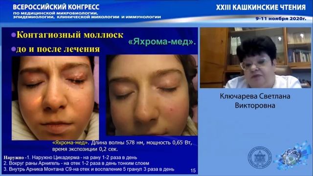 Новообразования периорбитальной области: особенности и сложности лечения
