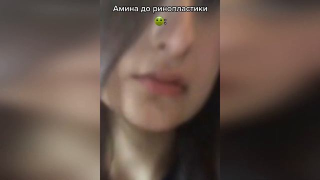 TENDERLYBAE ДО РИНОПЛАСТИКИ И ПОСЛЕ | СЛИВ АМИНЫ | ВСЕ ФОТО БЕЗ МАСКИ | ТЕНДЕРЛИБАЕ
