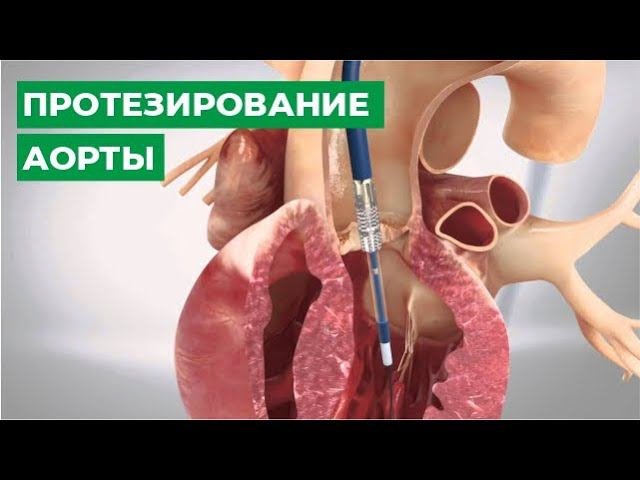 Протезирование аорты