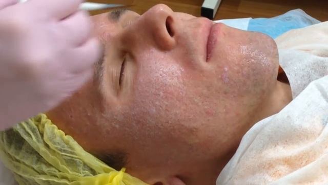 АирисКом студенты учатся: применение ТСА пилингов в косметологии. смотреть онлайн