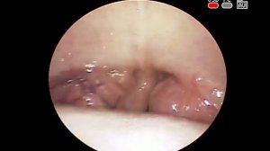 #Хронический #тонзиллит Гипертрофия небных #миндалин 3 степени #tonsil hypertrophy