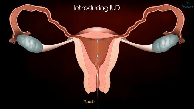 Intrauterine Device (IUD) Copper T Removal procedure - Patient Education Medical animation смотреть онлайн