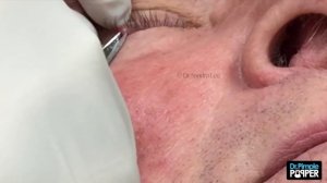 Removing a whitehead from the conjunctival rim