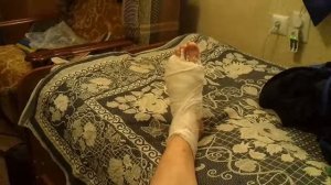 Гипс на ноге
