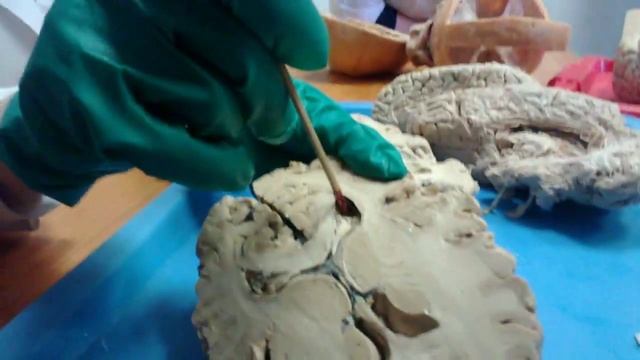 Анатомия ЦНС базальные ядра смотреть онлайн