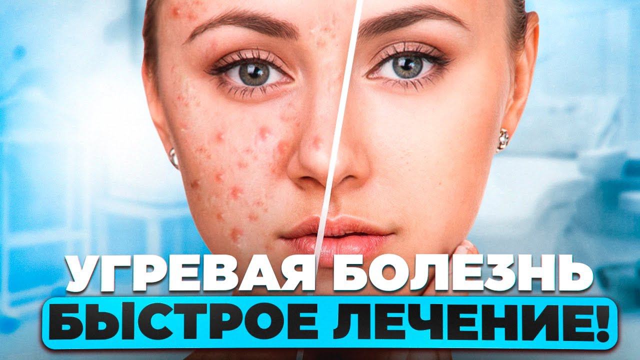 Как мы вылечили АКНЕ за 2 месяца? Самый быстрый и эффективный процесс лечения!
