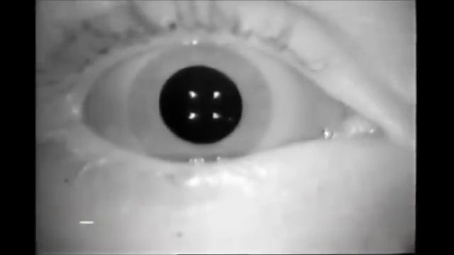 Виды нистагма смотреть онлайн