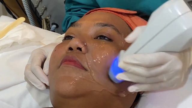 CHUBBY CHEEKS - BTL EXILIS IS THE ANSWER! смотреть онлайн