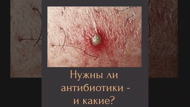 ЛЕЧЕНИЕ ВРОСШИХ - ПОСОБИЕ! смотреть онлайн