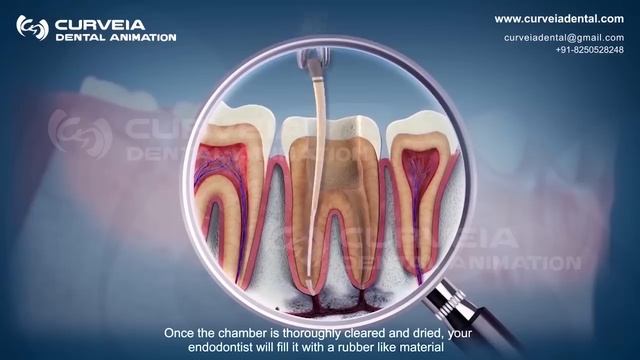 Root Canal Treatment step by step | Curveia Dental Animation in 3D - Endodontics for tooth decay смотреть онлайн