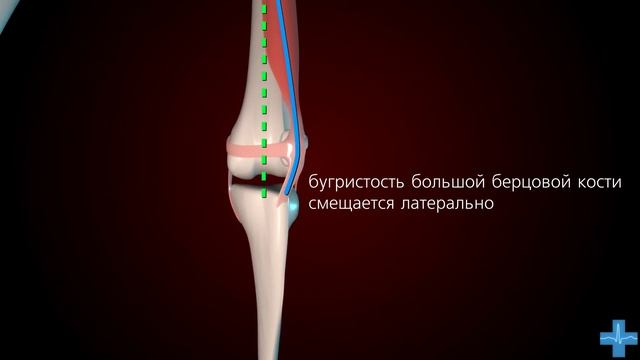 Вывих надколенника. Причины/Patellar Dislocation смотреть онлайн
