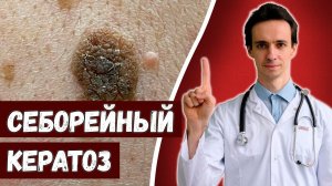 Себорейный кератоз Что это и как лечить?